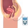 Globus G6724 Sonda Anale Mono Paziente – Accessorio per Elettrostimolazione del Pavimento Pelvico